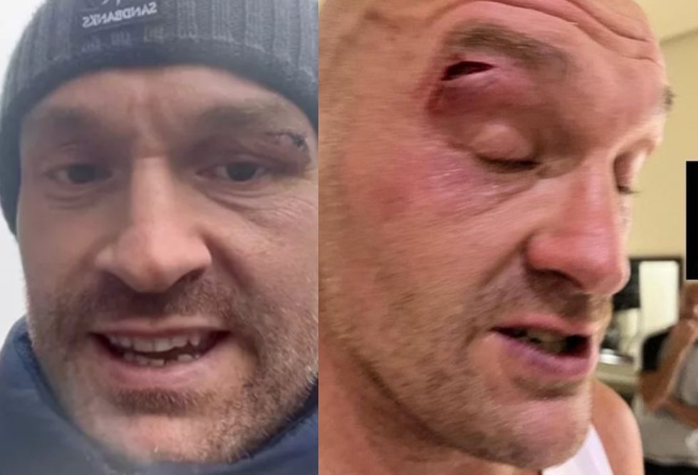 Tyson Fury shows latest damage to cut eye in new video